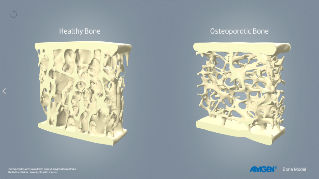 AMGEN  - 3D Interactivo - Hueso con osteoporosis